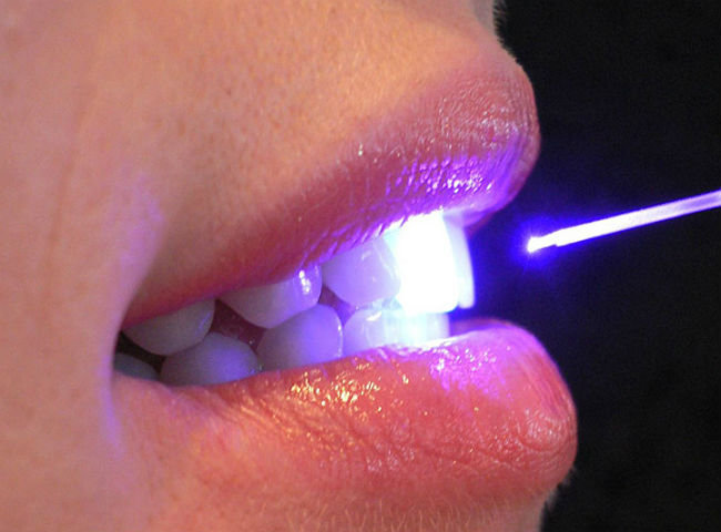 Laser na Odontologia